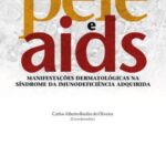 Pele e Aids: manifestações dermatológicas na síndrome da imunodeficiência adquirida